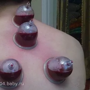 Кровопускание-хиджама в оздоровительном центре Алматы